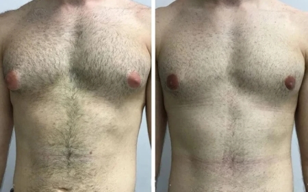 Patient Stories: Real Results from the Best Doctors in Dubai for Gynecomastia