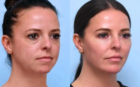 Best Aesthetic Clinic in Dubai: Thread Lift for Jawline and Neck – Define Your Features Without Surgery