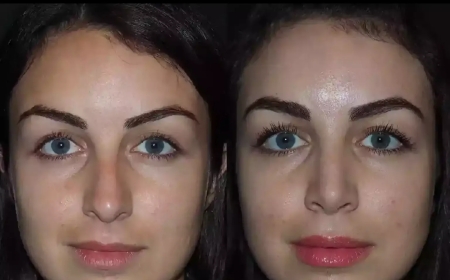 What to Expect During Your Nose Surgery in Dubai Consultation