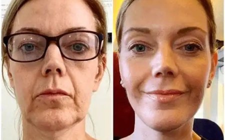 Fuel Vibrancy with Profhilo at the Best Plastic Surgeon in dubai