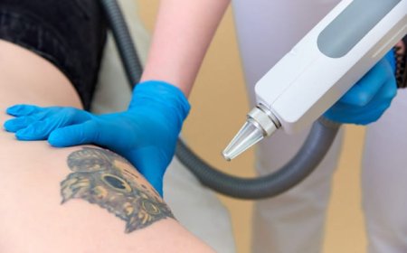 How Laser Tattoo Removal Works for Fast and Safe Skin Recovery