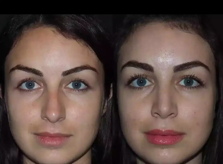 What to Expect During Your Nose Surgery in Dubai Consultation