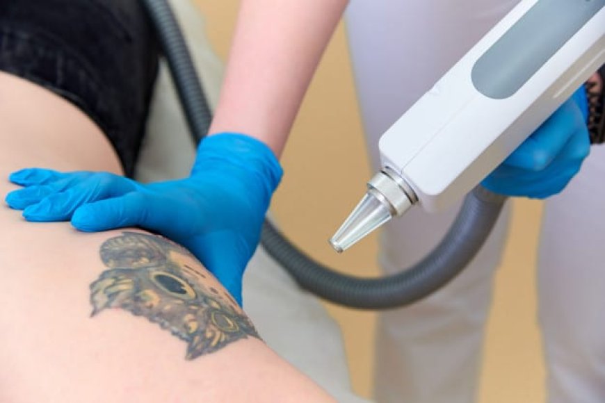 How Laser Tattoo Removal Works for Fast and Safe Skin Recovery