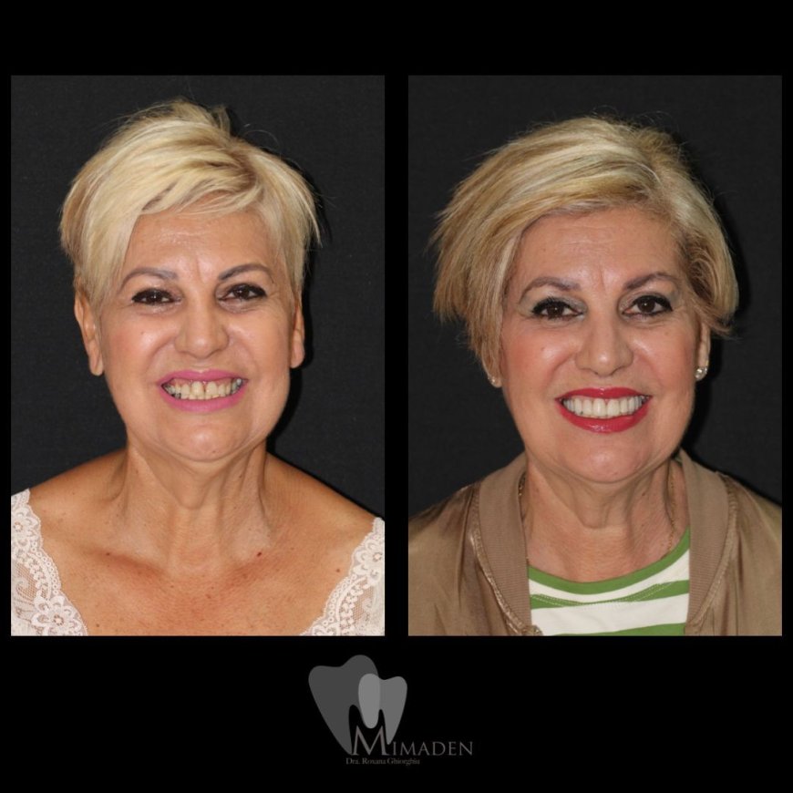 Carillas Dentales en Hospitalet de Llobregat Estética Dental de Alta Calidad