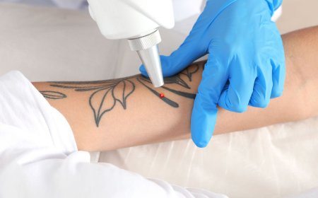 Best Time to Start Laser Tattoo Removal for Fast, Lasting Results