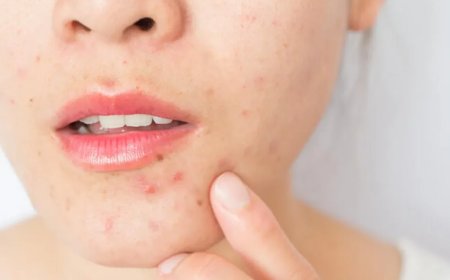 Acne Treatment That Works Overnight for Visible Skin Improvement