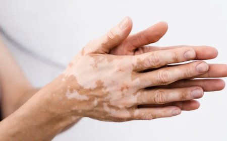 Effective Treatment Options for Vitiligo