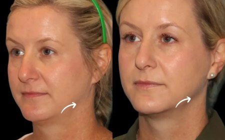The Link Between Hormones and Sculptra Fillers Treatments in Dubai