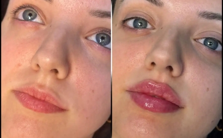 Why the Best Doctors in Dubai Should Be Your Choice for Fillers