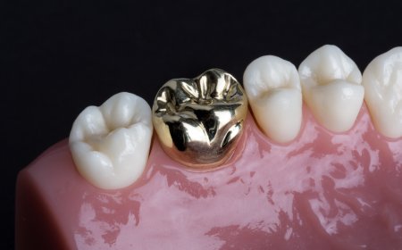 The Role of Crowns and Bridges in Restorative Dentistry in Islamabad