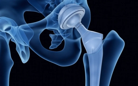 Total Hip Arthroplasty: Procedure, Benefits, and Recovery Guide