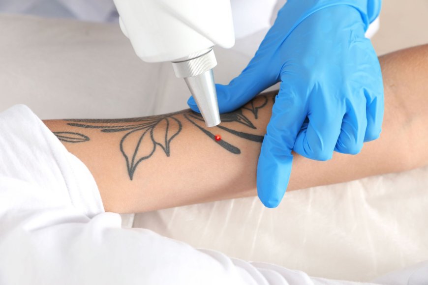 Best Time to Start Laser Tattoo Removal for Fast, Lasting Results