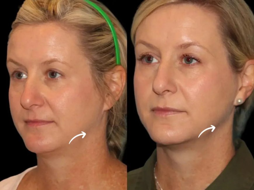 The Link Between Hormones and Sculptra Fillers Treatments in Dubai