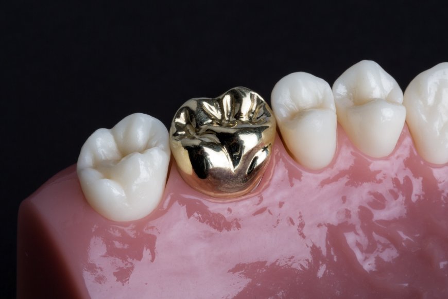 The Role of Crowns and Bridges in Restorative Dentistry in Islamabad